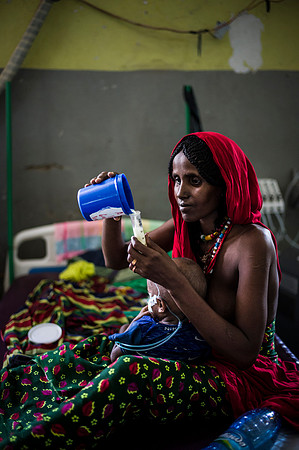 Asiya Utban, 2yo with severe acute malnutrition and being tube fed