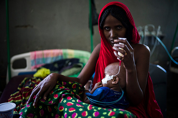 Asiya Utban, 2yo with severe acute malnutrition and being tube fed
