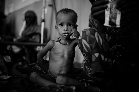I know this is a typical sight of malnutrition of yet another African child but this is reality and the situation is dire.