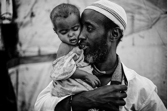 His 1yo daughter suffered what seemed like acute malnutrition and could barely stay upright